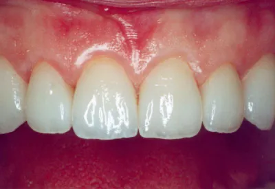Porcelain Veneers